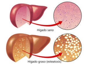 Lee más sobre el artículo El hígado graso puede detectarse a tiempo: estos son los síntomas a los que hay que prestar atención